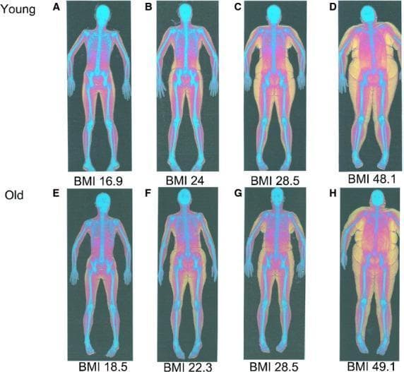 This diagnostic image display consists of eight whole-body dual-energy X-ray absorptiometry (DEXA) scans categorized by age (Young vs. Old) and Body Mass Index (BMI). The series illustrates variations in body composition across a spectrum ranging from underweight to obese. A standardized color-coding system is used to visualize tissue types: blue represents bone mineral density, red indicates lean soft tissue (muscle), and yellow signifies adipose (fat) tissue.
The 'Young' cohort (A-D) shows a progression from a predominance of red and blue with minimal truncal yellow in the underweight scan (BMI 16.9) to extensive, diffuse yellow adipose deposition throughout the trunk and extremities in the obese scan (BMI 48.1). The 'Old' cohort (E-H) demonstrates similar adiposity trends but visually reflects age-related changes, such as potential sarcopenia and altered fat distribution. These scans are used in clinical and educational settings to assess metabolic health, sarcopenic obesity, and the impact of aging on musculoskeletal integrity. The visuals provide a clear comparison of how BMI and chronological age influence the ratio and anatomical distribution of fat, lean mass, and bone.