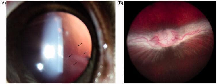 This composite of two ophthalmic images demonstrates the safety profile and drug depot characteristics following an intravitreal injection of a prodrug (HDP-PMEG). Image A is a slit-lamp photograph using retroillumination, captured at 6 weeks post-injection. It reveals the presence of fine, particulate drug particles suspended within the vitreous humor (marked by black arrows), demonstrating the slow-release properties of the minimally water-soluble crystalline prodrug. Image B provides a wide-field fundus view of the same subject at 8 weeks post-injection. This image serves as a clinical safety comparison, showing a healthy retinal background, a well-defined and normal optic nerve head, and the characteristic appearance of the medullary ray without evidence of inflammation, retinal hemorrhage, or whitening. These images are used in ophthalmology to illustrate drug delivery mechanics, specifically the formation of a vitreous depot and its long-term biocompatibility within the posterior segment.