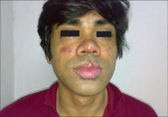 This clinical photograph shows the facial features of a male patient presenting with cutaneous manifestations of Systemic Lupus Erythematosus (SLE). A characteristic malar rash is visible, appearing as erythematous, slightly edematous plaques distributed over the bridge of the nose and extending symmetrically across the cheeks in a 'butterfly' pattern, notably sparing the nasolabial folds. Additional findings include discoid lupus erythematosus (DLE) lesions on the lips, characterized by prominent scaling, crusting, and focal areas of depigmentation and hyperpigmentation along the vermilion border. Scattered erythematous macules are also present on the peri-orbital and malar regions. These visual signs are primary diagnostic indicators for autoimmune connective tissue diseases. The educational focus is on identifying the classic distribution of acute and chronic cutaneous lupus manifestations.