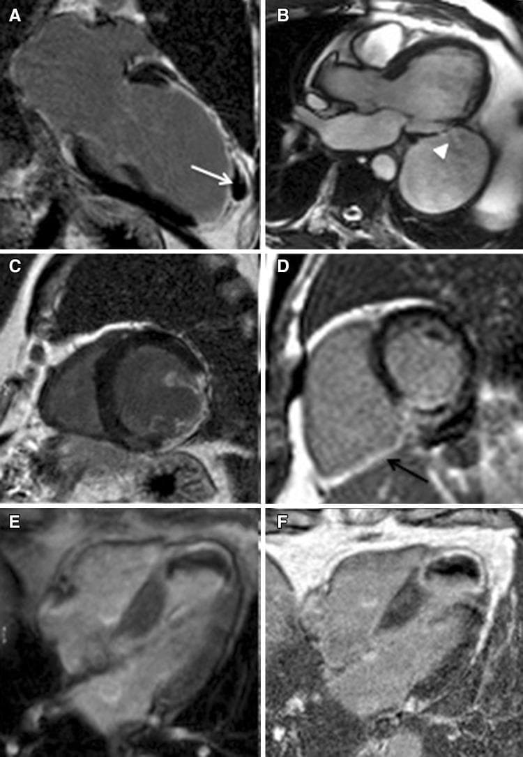This composite of cardiac magnetic resonance (CMR) images illustrates various mechanical and ischemic complications following acute myocardial infarction. (A) Two-chamber long-axis post-contrast view showing a contained chronic rupture of the anterior left ventricular (LV) wall (white arrow). (B) Three-chamber long-axis cine frame demonstrating a large pseudo-aneurysm of the mid-cavity inferolateral wall with a narrow 'tunnel-like' connection (white arrowhead) showing active flow. (C) Short-axis post-contrast image identifying myocardial infarction within the papillary muscles. (D) Short-axis post-contrast sequence highlighting right ventricular (RV) inferior wall involvement (black arrow) associated with basal inferior LV infarction. (E, F) Four-chamber long-axis views in early and late gadolinium enhancement phases, respectively, depicting a large apical thrombus. The thrombus is characterized by a persistent low-signal (dark) intensity in both phases due to its avascular nature. These diagnostic images are essential for characterizing structural damage, identifying myocardium at risk, and distinguishing between true and pseudo-aneurysms in the setting of coronary artery disease.
