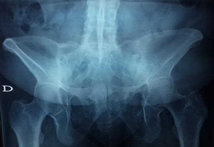 Anteroposterior (AP) pelvic radiograph demonstrating significant chronic changes of the axial skeleton, characteristic of advanced ankylosing spondylitis. The primary diagnostic finding is bilateral grade 4 sacroiliitis, visualized as complete bony ankylosis (fusion) of both sacroiliac joints. The normal joint spaces between the sacrum and iliac bones are entirely obliterated, replaced by continuous bony bridging. The lower lumbar spine shows signs of syndesmophyte formation and vertical fusion, contributing to the 'bamboo spine' appearance often associated with this pathology. The pelvic ring remains intact, and the iliac crests are well-defined. Both hip joints (femoroacetabular joints) are visualized, with the femoral heads well-seated within the acetabula, though the image focus remains on the sacroiliac and spinal involvement. This diagnostic image is used to teach the progression of seronegative spondyloarthropathies and the radiographic criteria for diagnosing advanced sacroiliitis.