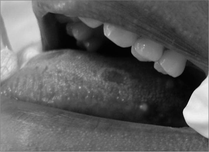 This clinical photograph displays an intraoral view of the tongue's dorsal and lateral surfaces, showcasing two distinct pathologies. On the dorsal surface, there are multiple well-demarcated erythematous patches surrounded by a thin, raised, serpiginous white border, classic for benign migratory glossitis (geographic tongue). On the posterolateral margin of the tongue, there is a distinct, solitary, rounded yellowish papule approximately 5 mm in diameter. This lesion, which was histologically diagnosed as an oral lymphoepithelial cyst, appears smooth and submucosal. The image serves as an educational tool for differential diagnosis of oral mucosal lesions, illustrating the coexistence of a common inflammatory condition (geographic tongue) and a rarer benign cystic lesion (lymphoepithelial cyst) in the same patient. This is relevant for clinical specialties such as oral medicine, dermatology, and otolaryngology.