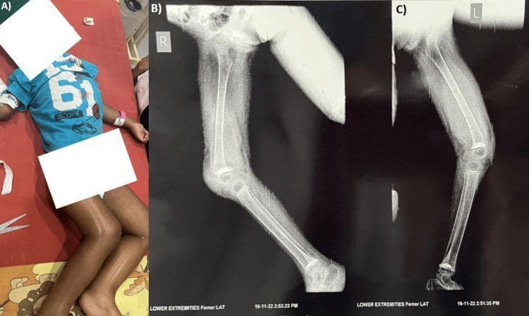 This composite educational material consists of a clinical photograph and lateral radiographs illustrating pediatric scurvy (Vitamin C deficiency). Panel A is a clinical photograph of a pediatric patient exhibiting signs of severe acute malnutrition (SAM), including muscle wasting and thinning of the extremities. Panels B and C are lateral X-ray images of the right and left lower limbs, respectively. The radiographs demonstrate pathognomonic radiological signs of scurvy at the knee joint. Key findings include the 'white line of Frankel,' which is a dense, sclerotic band at the metaphysis representing a zone of provisional calcification. Visible at the metaphyseal margins are 'corner signs' (Pelkan spurs), which are small, triangular bony outgrowths. The epiphyses of the distal femur and proximal tibia show a 'Wimberger ring sign,' characterized by a dense sclerotic periphery surrounding a radiolucent center. Additionally, generalized osteopenia and cortical thinning are observed in the long bones. These images serve as a classic diagnostic reference for the musculoskeletal manifestations of vitamin C deficiency in a pediatric population.