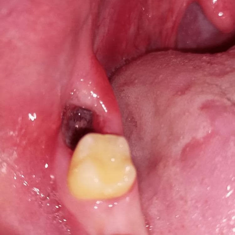 This clinical photograph illustrates a case of alveolar osteitis, commonly known as a dry socket, following the extraction of a mandibular right third molar. The image shows a posterior view of the oral cavity, focusing on the mandibular alveolar ridge distal to the second molar. The extraction site presents as a dark, cavernous void, indicating a total or partial loss of the protective blood clot. The surrounding gingiva and alveolar mucosa exhibit significant pathology, characterized by intense erythema, edema, and a loss of healthy stippling. The tissue appears smooth and glossy, which is a hallmark of acute inflammation. This visual representation is used in dental education to teach the diagnostic features of post-extraction complications, specifically highlighting the absence of granulation tissue within the socket and the reactive inflammatory changes in the adjacent soft tissues. The image serves as a clinical reference for oral surgeons and dental students to identify the classic presentation of dry socket in the third molar region.