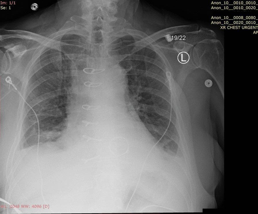 Anteroposterior (AP) chest X-ray demonstrating features of acute pulmonary edema in a clinical setting. The lung fields show bilateral, symmetric, diffuse hazy opacities with a predominant distribution in the lower zones. Increased interstitial markings and patchy airspace opacities suggest alveolar fluid accumulation. The cardiomediastinal silhouette appears slightly enlarged. Several medical monitoring and support devices are present, including multiple external ECG leads and wires superimposed on the thorax, a right-sided central venous catheter with the tip projecting toward the superior vena cava, and a left-sided thin tubular structure consistent with a drainage tube or monitoring line. The bony structures, including the clavicles, ribs, and scapulae, are intact. This imaging is characteristic of pulmonary vascular congestion and fluid overload, often seen in the context of acute heart failure or severe valvular dysfunction such as mitral regurgitation.