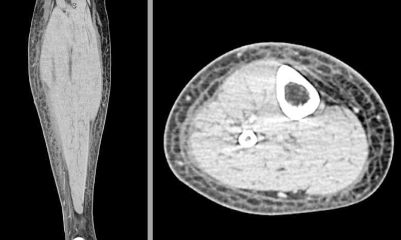 This diagnostic image displays a CT scan of the right lower extremity in two planes: a coronal view (left) and an axial cross-section (right). The primary pathology demonstrated is extensive subcutaneous edema, characterized by marked thickening and a diffuse reticular, honeycomb-like pattern within the subcutaneous fat layer. This 'cobblestoning' appearance is highly suggestive of an inflammatory or infectious process such as cellulitis. In both views, the deep muscle compartments appear enlarged and slightly hyperattenuating, likely due to reactive inflammation or lymphedema, though they remain well-demarcated from the subcutaneous layer by the deep fascia. The axial view confirms the circumferential nature of the soft tissue swelling. Key anatomical landmarks visible include the tibia and fibula, which show intact cortical bone without signs of osteomyelitis or periosteal reaction. No discrete fluid collections, abscesses, or pockets of subcutaneous gas are visualized, findings that are critical in differentiating simple cellulitis from necrotizing fasciitis or localized abscess formation in a clinical setting.