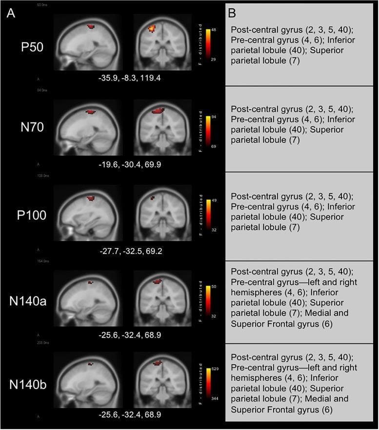This medical figure presents current density reconstructions (CDR) and corresponding anatomical localizations for cortical somatosensory evoked potential (CSEP) waveform components (P50, N70, P100, N140a, and N140b) in children with normal hearing. Panel A displays sLORETA-derived cortical activations mapped onto sagittal and coronal MRI slices, accompanied by MNI coordinates. The likelihood of activation is indicated by an F-distribution color scale ranging from black (minimum) to yellow (maximum). Panel B provides a summary table of the significant brain regions involved. For the early components (P50, N70, P100), activation is primarily localized to the left hemisphere within the post-central gyrus (Brodmann areas 2, 3, 5, 40), pre-central gyrus (BA 4, 6), and the inferior/superior parietal lobules (BA 40, 7). Late components (N140a, N140b) demonstrate similar parietal activity but show additional involvement of the medial and superior frontal gyri (BA 6) and bilateral activation of the pre-central gyrus. These maps illustrate the typical spatio-temporal progression of cortical processing following right-sided vibrotactile stimulation.