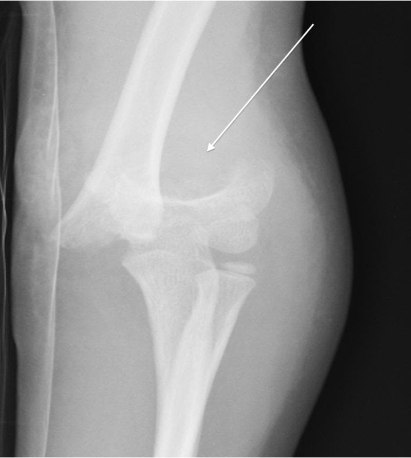 This diagnostic image is an anteroposterior (AP) view radiograph of a pediatric elbow, demonstrating a severe supracondylar humerus fracture, classified as a Gartland Type 3. The imaging shows a complete cortical discontinuity in the distal humeral metaphysis, immediately proximal to the epicondyles. A white arrow highlights the fracture site where there is significant posterolateral displacement and misalignment of the distal fragment relative to the humeral shaft. The normal anatomical relationship between the distal humerus, proximal radius, and ulna is disrupted, suggesting associated joint instability or dislocation. Pediatric growth plates are visible at the proximal radius and ulna, consistent with the patient's age. This radiograph illustrates a common orthopedic emergency in children, typically resulting from a fall on an outstretched hand (FOOSH), and is used to teach fracture classification, assessment of neurovascular risk, and the necessity of surgical reduction.