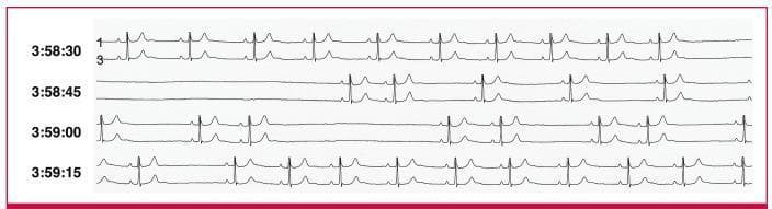 This diagnostic image shows a continuous 24-hour Holter electrocardiogram (ECG) rhythm strip illustrating severe sinus node dysfunction. The tracing is organized into four sequential time segments labeled from 3:58:30 to 3:59:15. The first segment shows a stable sinus rhythm with identifiable P waves, narrow QRS complexes, and prominent T waves. The second segment (3:58:45) captures a prolonged asystolic pause lasting approximately seven seconds, characterized by a complete absence of P-QRS-T complexes without any ventricular escape beats, indicative of sinus arrest. Subsequent segments (3:59:00 and 3:59:15) demonstrate a return to sinus rhythm interrupted by shorter, intermittent pauses. These shorter pauses are consistent with sino-atrial (SA) exit block, where P waves are absent at expected intervals. The image serves as an educational tool for distinguishing between types of sinus node pauses and illustrates the clinical presentation of symptomatic bradyarrhythmia requiring pacemaker intervention.