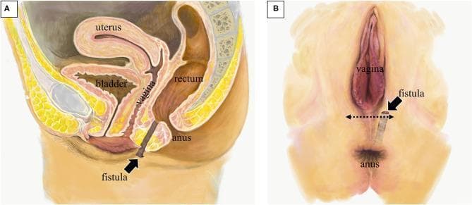 Anatomical illustration depicting a rectoperineal fistula in a female patient, presented in two panels. Panel A shows a sagittal diagram of the female pelvis, labeling the bladder, uterus, vagina, rectum, and anus. A dark-shaded fistula tract is visible originating from the anterior wall of the lower rectum, passing posterior to the vagina, and terminating at an external opening in the perineal skin. Panel B displays a surface view of the perineum in the lithotomy position. The external fistula opening is indicated adjacent to the vaginal orifice and superior to the anus. A horizontal dotted double-arrow illustrates the planned site for a transverse surgical incision between the vaginal orifice and the fistula opening. The diagram highlights the relationship between the fistulous tract and the rectovaginal septum, distinguishing it from a rectovaginal fistula as the tract avoids the vaginal canal and opens directly onto the perineum. This educational visual is relevant for colorectal surgery, gynecology, and anatomical study of pelvic floor pathologies.