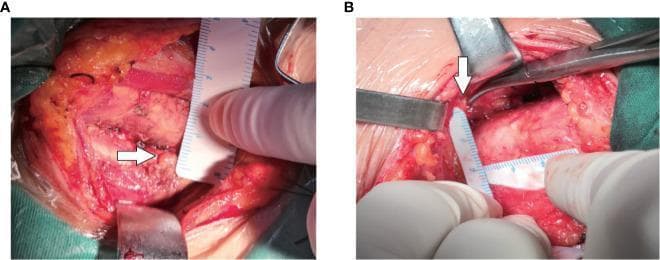 Two intraoperative clinical photographs (A and B) demonstrating the identification and spatial measurement of the inferior parathyroid gland (IPG) during neck surgery. In both panels, a white arrow points to the IPG, which appears as a small, yellowish-tan, oval structure nestled within the surgical field. The surrounding anatomy includes reddish striated muscle fibers, thyroid tissue, and yellowish adipose tissue. A sterile millimeter ruler is visible in both images, held by a gloved hand to measure the distance between the IPG and fixed anatomical landmarks, such as the trachea or cricoid cartilage. Surgical instruments, including a retractor and fine forceps, are utilized to expose the site and maintain a clear view of the IPG's location. This visual demonstrates the clinical application of preoperative ultrasound coordinates to accurately locate parathyroid glands intraoperatively, facilitating safe dissection and preservation of the gland.