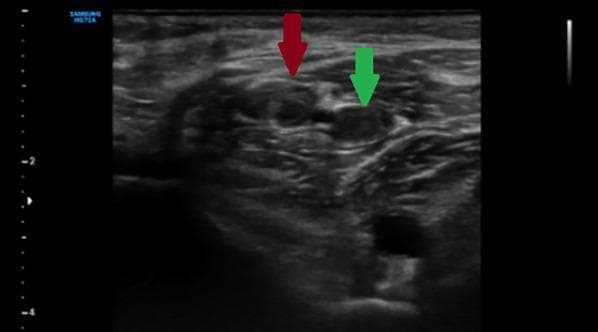 This diagnostic image is a B-mode grayscale ultrasound in the transverse plane demonstrating deep vein thrombosis (DVT) in the gastrocnemius veins of the lower extremity. The image captures a compression maneuver, a key diagnostic technique where external pressure is applied with the transducer. Two rounded venous structures are highlighted: the red arrow points to a vein containing visible echogenic material (thrombus), and the green arrow indicates a neighboring vein that remains patent but fails to collapse under pressure. The surrounding muscular and subcutaneous tissue exhibits a heterogeneous echotexture with hyperechoic fascial planes. The failure of venous coaptation (non-compressibility) despite active pressure is a definitive sonographic sign of acute or subacute venous thrombosis. This clinical finding is essential for medical education regarding vascular emergencies and the sonographic evaluation of calf pain or swelling.