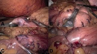 This composite of four laparoscopic intraoperative clinical photographs (A-D) illustrates key steps in a bariatric/metabolic surgical procedure, specifically a sleeve gastrectomy followed by a duodenoileal anastomosis. Panel A shows the initial duodenal transection using a linear surgical stapler distal to the pylorus. Panel B demonstrates the sequential firing of a laparoscopic linear stapler along the greater curvature of the stomach to create the gastric sleeve, with visible staple lines and gastric tissue compression. Panel C depicts the first row of a manual or stapled duodenoileal anastomosis, showing the approximation of the proximal duodenum to a loop of ileum. Panel D displays the final aspect of the end-to-side duodenoileal anastomosis, characterized by a secure, sutured junction between the digestive segments with healthy, well-perfused tissue margins and minimal surgical bleeding. The images highlight critical anatomical landmarks including the pyloric region, duodenum, and ileum, emphasizing surgical techniques for tissue resection and reconstruction in laparoscopic gastrointestinal surgery.