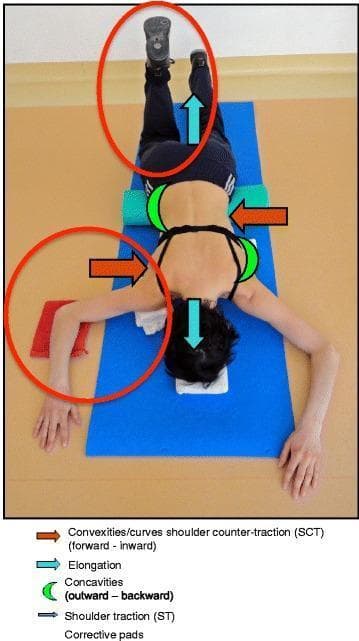 This clinical photograph illustrates a patient performing the Schroth prone exercise, a Physiotherapeutic Scoliosis-Specific Exercise (PSSE) designed for three-dimensional spinal correction. The patient is positioned prone on a blue mat with the head resting on a pillow and a green lumbar roll supporting the lower torso. The legs are elevated vertically against a wall. Visible annotations detail the biomechanical corrective forces: blue arrows indicate axial trunk elongation (cranial and caudal forces), while red arrows denote muscle activation directed toward the midline (shoulder counter-traction) to correct spinal convexities. Green half-moon symbols represent the intended expansion of spinal concavities in an outward-backward direction. Red circles highlight specific corrective focal points, including iliopsoas muscle activation via right hip flexion and shoulder traction/counter-traction aimed at reducing thoracic and lumbar curves. This therapeutic modality focuses on active self-correction, rotational angular breathing, and postural stabilization to manage idiopathic scoliosis and mitigate curve progression.