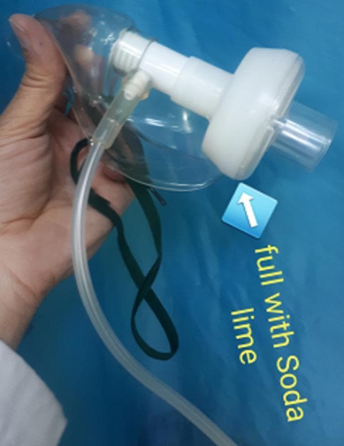 A clinical photograph displaying a modified respiratory face mask assembly designed for non-invasive ventilation. The apparatus consists of a clear plastic oxygen mask with dark elastic head straps and a flexible oxygen supply tube. Central to the modification is a white, rigid plastic cylindrical housing connected directly to the mask's main port. This housing is annotated as being 'full with Soda lime', acting as a carbon dioxide (CO2) absorbent filter within the expiratory circuit. This clinical setup is intended to mitigate hypercapnia in patients, such as those with severe COVID-19, by reducing the re-breathing of CO2. The image demonstrates a specialized adaptation of standard medical equipment for advanced respiratory support, focusing on preventing the need for invasive tracheal intubation through effective dead-space gas management.