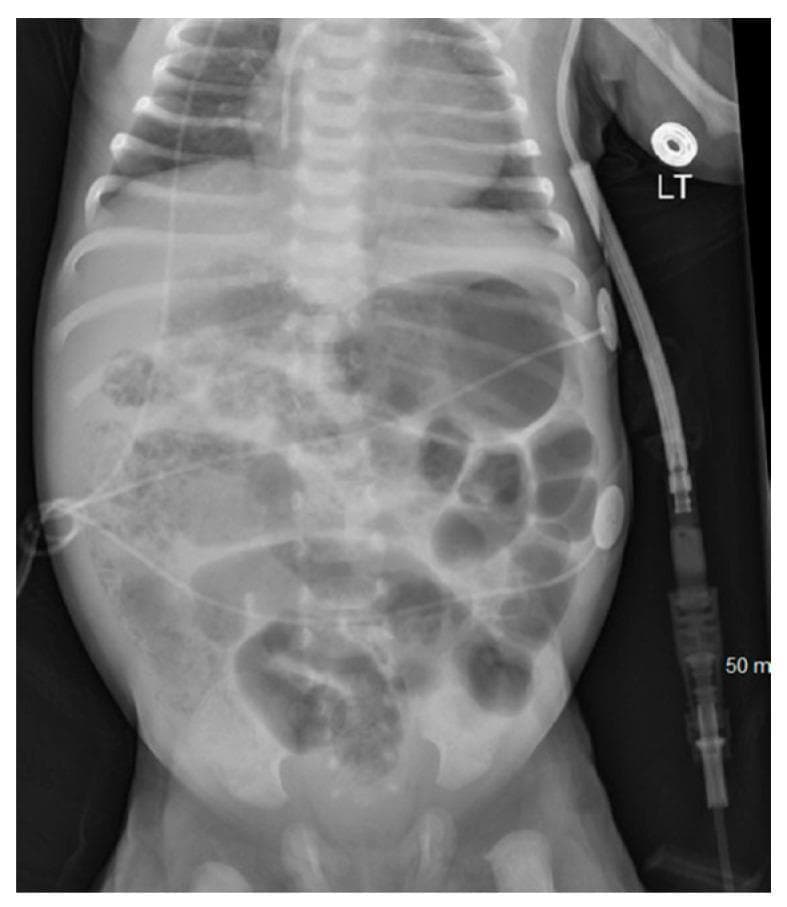 This diagnostic image is an anteroposterior (AP) abdominal X-ray of a neonate. The primary finding is diffuse dilation of multiple bowel loops throughout the abdominal cavity. Notably, the radiograph demonstrates classic signs of pneumatosis intestinalis, characterized by linear and curvilinear radiolucent areas (intramural air) within the walls of the dilated intestinal loops. This radiographic finding is highly suggestive of Necrotizing Enterocolitis (NEC) in this clinical context. There is no clear evidence of pneumoperitoneum visible in this view. Externally, several medical devices are present, including an umbilical catheter extending superiorly, ECG leads on the lateral abdominal walls, and a large-bore drainage or monitoring tube on the right side marked with '50 m' and secured with an adhesive disc labeled 'LT'. The image serves as a critical educational example of pediatric gastrointestinal pathology and neonatal intensive care monitoring.