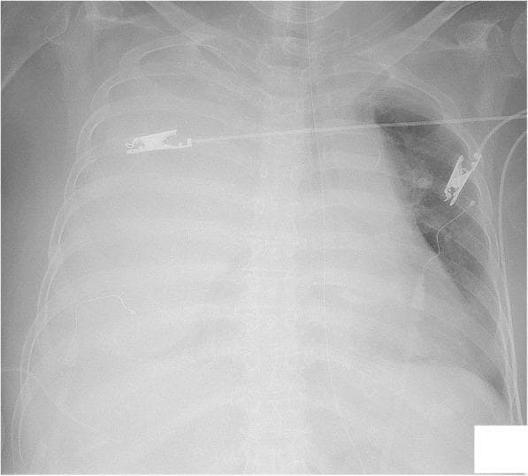 This diagnostic image is an anteroposterior chest X-ray demonstrating a massive right-sided hemothorax. The right hemithorax shows near-complete opacification with a significant increase in radiodensity, resulting in the obscuration of the right lung parenchyma, hemidiaphragm, and costophrenic angle. This appearance is characteristic of a large-volume pleural effusion, which in this clinical context represents blood accumulation. In contrast, the left lung field remains predominantly radiolucent, showing aerated lung tissue despite some mild peri-hilar haziness. Several medical devices are visible: a chest tube is positioned in the right pleural space, secured with an external clip, and a horizontal catheter or wire crosses the upper thoracic region. Additional monitoring leads and an external clip on the left side are also present. The clinical significance of this radiographic finding includes severe respiratory compromise and hemorrhagic shock, requiring urgent intervention such as drainage and stabilization of coagulation dysfunction.