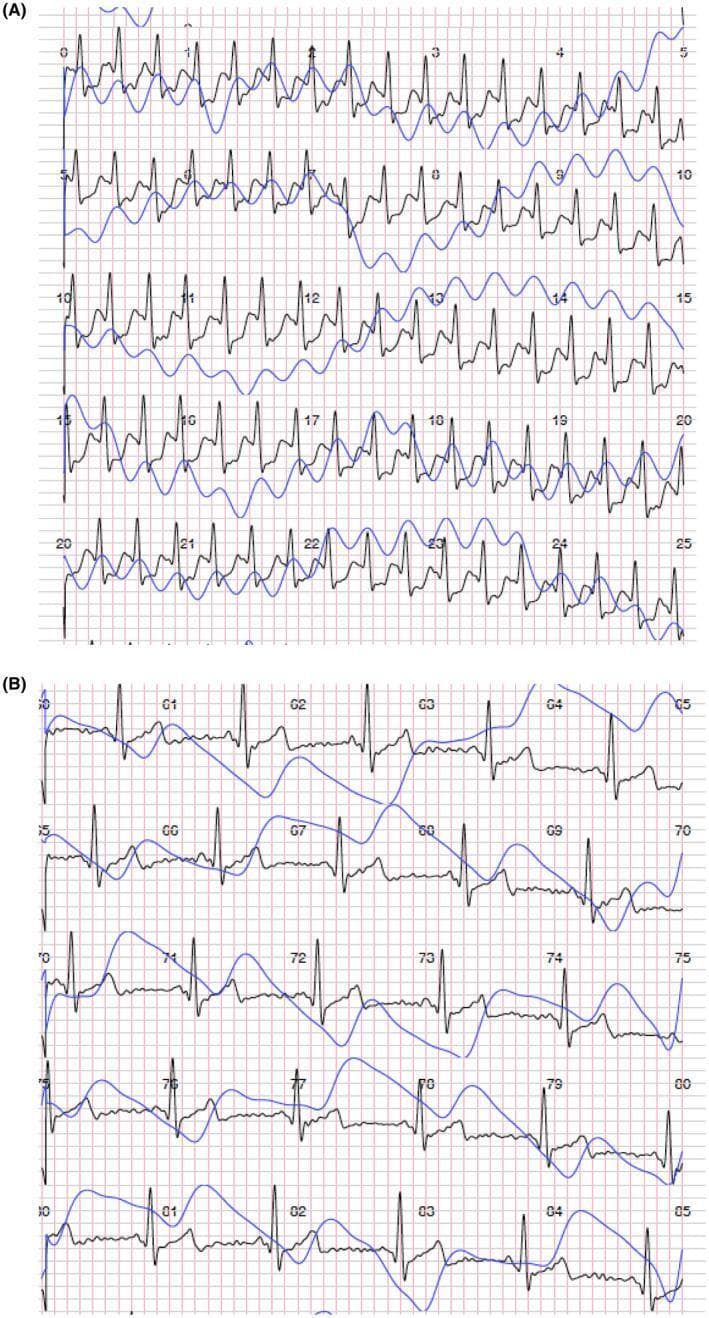 Comparison of diagnostic physiological traces illustrating supraventricular tachycardia (SVT) and its conversion to normal sinus rhythm. Panel A displays a continuous single-track electrocardiogram (ECG, black line) and synchronized photoplethysmography (PPG, blue line). The ECG shows a narrow-complex tachycardia characterized by a rapid, regular ventricular rate and absent P-waves, consistent with SVT. The corresponding PPG trace in Panel A exhibits high-frequency, low-amplitude oscillations, reflecting reduced stroke volume during the tachycardic event. Panel B demonstrates the physiological state following a successful Valsalva maneuver intervention. The ECG shows a restoration of normal sinus rhythm with identifiable P-waves, QRS complexes, and T-waves at a significantly slower heart rate. The PPG trace in Panel B shows a corresponding decrease in frequency and an increase in pulse wave amplitude, indicating improved hemodynamics and stroke volume consistency. This comparison highlights the efficacy of vagal maneuvers in managing acute supraventricular arrhythmias and demonstrates the utility of integrated ECG-PPG monitoring in clinical cardiology for real-time cardiac rhythm analysis.