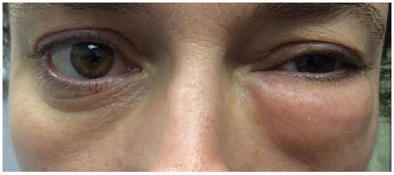 Clinical photograph of a patient's mid-face showing significant, asymmetrical left periorbital swelling. The left orbital region exhibits diffuse edema extending from the upper eyelid to the malar area, causing mechanical ptosis and narrowing of the palpebral fissure. The skin over the swollen area appears mildly erythematous and tense, distorting the natural facial contours. In contrast, the right eye and periorbital tissues appear normal with preserved lid margins and orbital architecture. This visual finding is characteristic of conditions leading to sudden volume increase in the subcutaneous periorbital space, such as orbital emphysema (often following trauma or nose blowing in the setting of an orbital floor fracture) or inflammatory processes. The presentation highlights the clinical signs of unilateral periorbital edema and its impact on ocular adnexa.