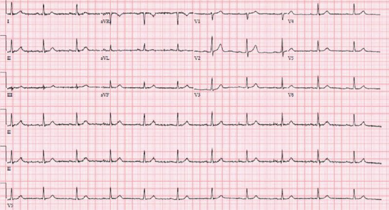 A standard 12-lead electrocardiogram (ECG) displayed on a traditional red grid background. The tracing shows a normal sinus rhythm with a regular rate and consistent R-R intervals. P waves are clearly visible preceding each QRS complex in the limb and precordial leads. The QRS complexes are of normal duration and morphology, with a standard R-wave progression observed from V1 through V6. The ST segments appear isoelectric without clear evidence of acute ST-elevation or depression in any lead. T waves are upright in most leads, with the exception of lead V1 and aVR, where inversion is a normal variant. This ECG represents a clinically stable cardiac state at the time of presentation, despite the patient's underlying severe coronary artery disease (CAD), including significant stenosis of the left anterior descending and left circumflex arteries. The absence of acute ischemic changes or pathological Q waves highlights that baseline ECGs can remain unremarkable even in the presence of severe structural heart disease.
