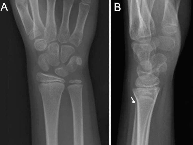 Two-view X-ray series (PA and lateral) of a pediatric right wrist demonstrating an angled distal radius buckle fracture (DRBF). The images show a skeletally immature individual with visible open physes (growth plates). Image A (posteroanterior view) shows subtle cortical irregularities at the distal radial metaphysis. Image B (lateral view) more clearly illustrates the pathology, marked by a white arrow pointing to a single focal cortical deflection or bulge along the dorsal aspect of the distal radius. This visual finding represents plastic deformation of the cortex without complete fracture line extension through the bone. The lack of significant displacement or involvement of the physis distinguishes this buckle fracture from more unstable pediatric injuries like Salter-Harris fractures. This diagnostic image is used to teach the identification of torus-type fractures in pediatric patients following axial loading injuries, such as a fall on an outstretched hand (FOOSH).