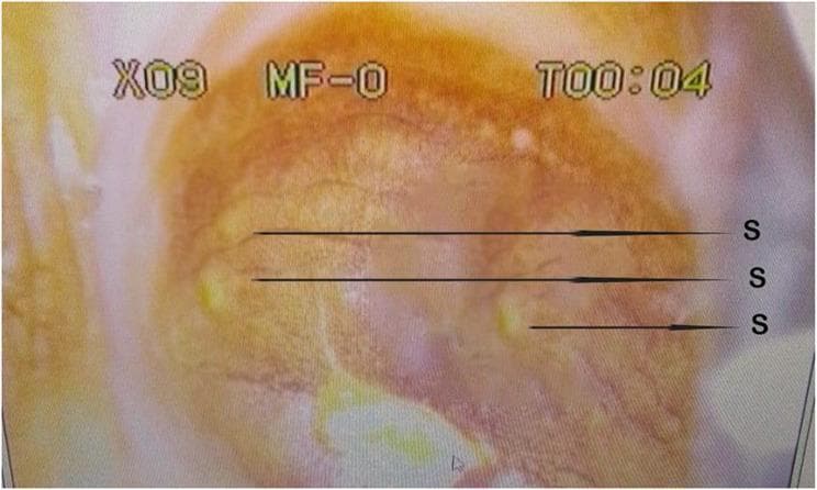 This colpophotograph displays the cervical mucosa following the application of Lugol’s iodine. The image captures a classic clinical presentation of colpitis macularis, commonly referred to as 'strawberry cervix.' The cervical surface shows a predominantly reddish-orange hue with an irregular texture. Key features, labeled with 'S', are small, discrete, raised papules that appear as pale or yellowish punctate spots against the background tissue. These spots represent focal areas of inflammation and capillary dilation or hemorrhage that do not take up the iodine stain (Schiller's test). While this finding is highly characteristic of Trichomonas vaginalis infection, the clinical context indicates a coinfection with female genital schistosomiasis. This diagnostic image is an essential teaching tool for identifying sexually transmitted infections and parasitic manifestations in gynecological examinations, highlighting the importance of colposcopy in visualizing subtle mucosal changes that may not be evident during a standard speculum exam.