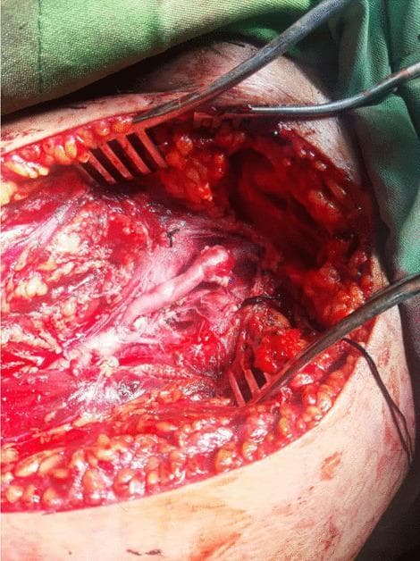 This clinical photograph captures an intraoperative view of a vascular reconstruction procedure. The image depicts a surgical field within the groin or thigh region, showing a longitudinal incision retracted by self-retaining and handheld metal retractors. The deep surgical site reveals an interposition saphenous vein graft used for a superficial femoral artery (SFA) repair. The graft is visible as a pale, glistening tubular structure bridging two arterial segments. The proximal and distal anastomoses are secured with fine, dark-colored monofilament sutures (likely Prolene), which appear to be applied in a continuous running fashion. The surrounding anatomy includes exposed muscle fibers, subcutaneous adipose tissue, and various levels of surgical hemostasis. The surgical field is moist and erythematous, consistent with an active open vascular procedure. This visual demonstrates the surgical management of a vascular injury, highlighting the technique of venous autograft interposition and arterial anastomosis in trauma or reconstructive surgery.