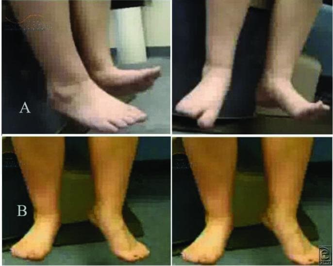 This clinical photograph comparison chart illustrates the preoperative and postoperative results of surgical intervention for a peroneal nerve injury. The image is divided into two sections: Panel A (upper) and Panel B (lower), each showing two views of the lower legs and feet. Panel A displays a patient with a clinical 'foot drop' of the right leg. The right foot is in a fixed plantarflexion position, unable to achieve active dorsiflexion, which is characteristic of common peroneal nerve palsy and a BMRC motor grade of 0/5. This lack of dorsiflexion leads to a neuropathic or steppage gait. Panel B demonstrates the postoperative outcome following peroneal nerve decompression, microneurolysis, and nerve transfer. The right foot now displays a more neutral alignment and significant improvement in active dorsiflexion, corresponding to a BMRC grade of 4/5. This surgical result allows for improved weight distribution and the restoration of a normal gait pattern. The educational focus is on the clinical presentation of peripheral nerve injury and the functional recovery possible through neurosurgical reconstruction.