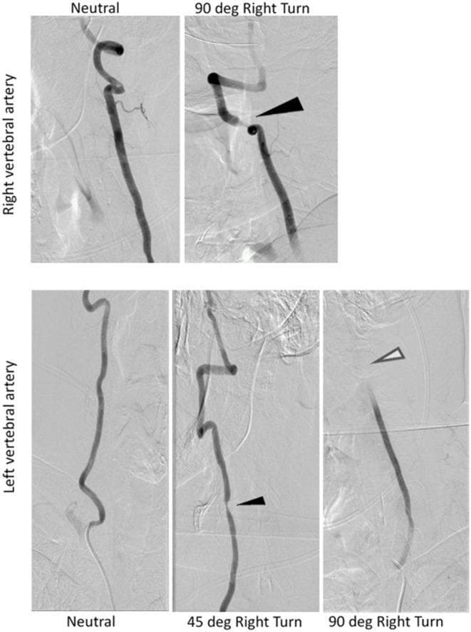 This diagnostic image set consists of dynamic digital subtraction angiography (DSA) frames of the vertebral arteries, illustrating rotational vertebral artery occlusion, also known as Bow Hunter's syndrome. The top row focuses on the right vertebral artery (RVA), comparing a neutral head position to a 90-degree right turn. In the neutral position, the RVA shows normal, patent flow. Upon a 90-degree right turn, a black arrow indicates significant focal narrowing/stenosis at the mid-cervical level (C4-C5), suggesting mechanical compression. The bottom row demonstrates the left vertebral artery (LVA) in three positions: neutral, 45-degree right turn, and 90-degree right turn. In neutral, the LVA is patent. At 45 degrees, a small black arrow highlights emerging partial stenosis. At 90 degrees, an open white arrow points to complete cessation of contrast flow, indicating total dynamic occlusion at the C1-C2 level. These images serve as a classic educational example of how head rotation can cause transient cerebrovascular insufficiency through mechanical obstruction by osteophytes or ligamentous stretching, correlating with clinical symptoms like vertigo or nystagmus.