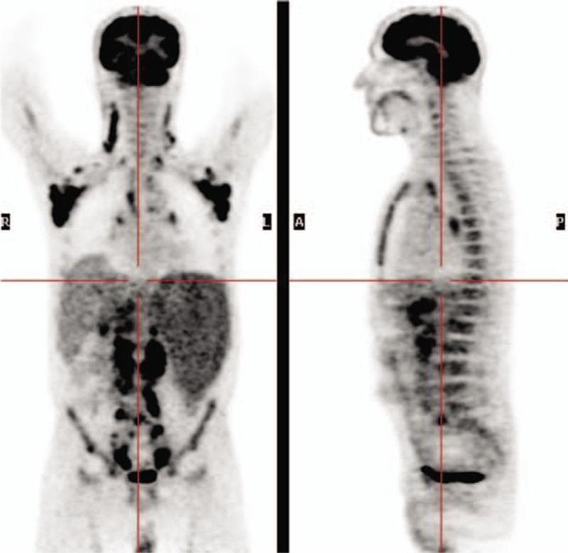 This diagnostic image consists of 18F-FDG PET/CT scans showing anterior (Maximum Intensity Projection - MIP) and sagittal views of a whole-body study at the time of diagnosis. The scans demonstrate widespread pathological fluorodeoxyglucose (FDG) accumulation in multiple anatomical regions. Distinct hypermetabolic foci are visible in several superficial and deep lymph node groups, including the cervical (neck), bilateral axillary, abdominal, and pelvic/inguinal regions (SUV max range 2–7.7). Physiological FDG uptake is noted in the brain, heart, and urinary bladder. The distribution pattern is consistent with Stage IV follicular non-Hodgkin lymphoma (fNHL), illustrating extensive lymphatic involvement both above and below the diaphragm. This imaging modality is used in oncology for baseline staging, evaluating disease burden, and identifying optimal sites for biopsy.