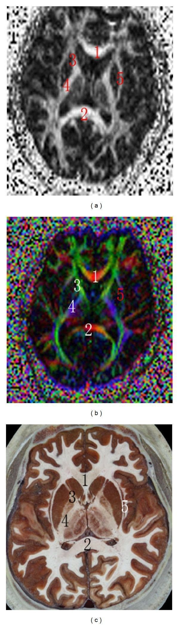 This composite figure presents a transversal comparison of human neuroanatomy at the level of the basal nuclei using three distinct modalities: (a) Fractional Anisotropy (FA) map, (b) Color Diffusion Tensor Imaging (DTI) map, and (c) a cross-sectional anatomical image. The images illustrate key white matter tracts and landmarks. Labels 1 and 2 indicate the genu and splenium of the corpus callosum, respectively; in the color DTI map, these are shown in red, signifying transverse fiber orientation. Label 3 identifies the anterior limb of the internal capsule (green in DTI, indicating anteroposterior orientation), while label 4 shows the posterior limb of the internal capsule (blue in DTI, indicating craniocaudal orientation). Label 5 highlights the region of the external and extreme capsules. The anatomical section (c) provides high-resolution morphological context, clearly delineating the boundaries between gray matter nuclei and white matter tracts that are interpreted via the FA and DTI maps. This comparison is used to teach neuroimaging correlations and the principles of tractography in clinical neurology and radiology.