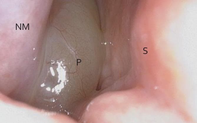 This clinical photograph displays a diagnostic nasal endoscopy of the nasal cavity, illustrating an obstructing case of chronic rhinosinusitis with nasal polyps (CRSwNP). The visual field reveals three primary anatomical landmarks: the inferior turbinate (labeled 'NM'), the nasal septum (labeled 'S'), and a large nasal polyp (labeled 'P'). The polyp is the dominant visual feature, appearing as a translucent, grayish-white, edematous mass with a smooth surface and fine visible surface vasculature. It occupies nearly the entire nasal airway, making contact with both the septum and the lateral wall structures. The surrounding mucosa of the inferior turbinate and septum appears typically pink and fleshy, providing a clear color contrast to the pale, gelatinous appearance of the polypoid tissue. This image serves as a classic educational representation of mechanical airway obstruction caused by significant sinonasal polyposis, common in otolaryngology for demonstrating disease staging and the necessity for therapeutic intervention.