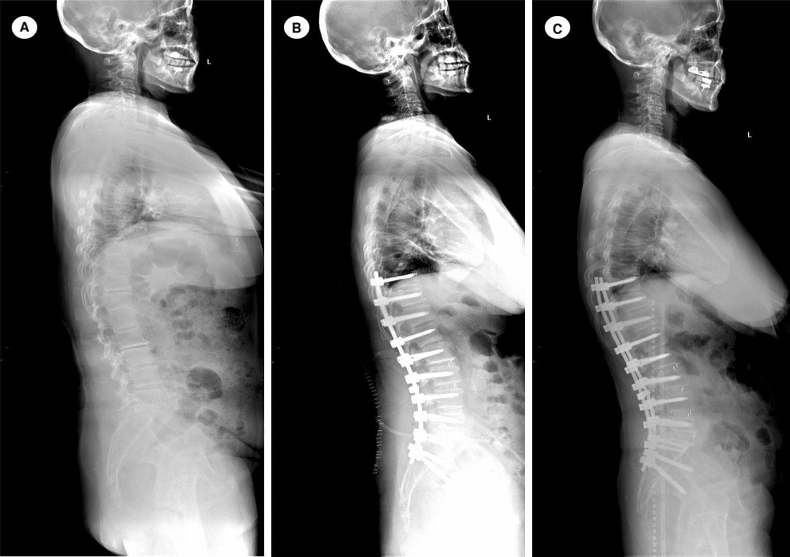 This diagnostic image consists of three side-by-side lateral full-spine radiographs (labeled A, B, and C) illustrating the surgical management of degenerative lumbar scoliosis (DLS).
Image A (Preoperative): Shows sagittal imbalance characterized by increased thoracic kyphosis and loss of lumbar lordosis, resulting in a forward-leaning posture.
Image B (Postoperative): Displays thoracolumbar fusion and stabilization with spinal instrumentation extending from T10 to S2. Posterior pedicle screws and rods are visible. The sagittal alignment is significantly corrected, restoring lumbar lordosis and achieving a more neutral Sagittal Vertical Axis (SVA), with the head positioned over the pelvis.
Image C (18-month Follow-up): Demonstrates a complication known as Proximal Junctional Failure (PJF). While the instrumentation remains intact, there is a pathologic focal kyphosis occurring at the vertebral levels immediately superior to the proximal end of the fusion construct (UIV). This failure results in a progressive forward sagittal tilt compared to the immediate postoperative state. The sequence serves as an educational example of spinopelvic parameter correction and subsequent junctional complications in long-construct adult spinal deformity surgery.