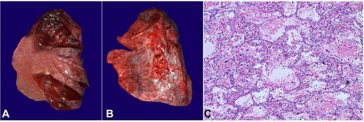 This composite image illustrates the gross and microscopic pathology of acute pulmonary edema and hemorrhage. Panels A and B provide a gross view of unfixed human lungs, showing a boggy, heavy, and markedly edematous appearance. The pleural surfaces are congested with visible darkening and focal areas of discoloration. Panel B specifically demonstrates the cut surface of the parenchyma with the exudation of frothy, serosanguinous fluid, a hallmark of severe pulmonary congestion. Panel C is a low-magnification photomicrograph (H&E stain) of the lung tissue. It reveals diffuse alveolar and interstitial edema, characterized by the accumulation of pale pink, proteinaceous fluid within the alveolar spaces. There is significant disruption of the normal alveolar architecture, accompanied by focal areas of intra-alveolar hemorrhage, evidenced by the presence of numerous red blood cells within the air spaces. These findings are clinically relevant in the context of congestive heart failure, fluid overload, or acute respiratory distress syndrome, illustrating the mechanical and histological consequences of pulmonary vascular congestion.
