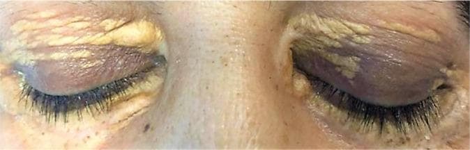 This clinical photograph of a patient with closed eyes demonstrates bilateral, symmetric xanthelasma palpebrarum. The primary findings are multiple sharply demarcated, yellowish plaques located on the medial and superior aspects of both the upper and lower eyelids. The lesions exhibit a velvety or slightly irregular texture and are concentrated around the inner canthi, extending laterally along the eyelid creases and partially toward the eyelash margins. The surrounding periorbital skin shows mild hyperpigmentation and fine wrinkling, particularly in the areas adjacent to the lipid deposits. There are no signs of acute inflammatory changes such as significant erythema or edema. These characteristic cutaneous markers are associated with localized cholesterol accumulations and may indicate underlying dyslipidemia or systemic histiocytic disorders, serving as an important diagnostic sign in dermatology and internal medicine.