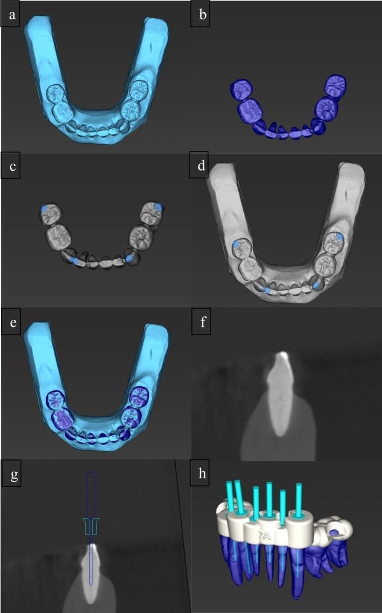 This composite image illustrates the digital workflow for static guided endodontics in managing calcified root canals. Subfigures (a) and (b) show the initial data acquisition via an intraoral scan (IOS) of a mandibular arch and a segmented Cone Beam Computed Tomography (CBCT) dental model. Panels (c), (d), and (e) demonstrate the registration and superimposition of these data sets within dental planning software, allowing for high-precision anatomical mapping. Subfigures (f) and (g) provide cross-sectional radiographic views showing the virtual planning of an access cavity; (g) specifically depicts a virtual drill path oriented toward the orifice of a calcified root canal to ensure a straight-line access. Panel (h) presents the final 3D design of a surgical template (endodontic guide) positioned over the dental arch. The template features sleeves and light blue cylinders representing the trajectory and depth control for the guided burs. This pedagogical visual summarizes the transition from diagnostic imaging to computer-aided design (CAD) for minimally invasive endodontic procedures.