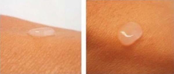 This clinical photograph displays a bioengineered dermal-epidermal skin substitute applied to a patient's skin, shown from both profile (left) and superior (right) perspectives. The substitute appears as a clear, humid, and translucent gel-like droplet that maintains structural integrity and distinct morphology without spreading or dissolving. It exhibits a smooth, reflective surface and adheres well to the underlying tissue. The transparency allows for visualization of the skin's surface texture beneath the graft. This type of scaffold, typically composed of fibrin-agarose and cultured cells like fibroblasts and keratinocytes, is designed for regenerative medicine applications to facilitate wound healing and skin replacement. The image demonstrates the physical properties and clinical handling characteristics of a laboratory-developed dermal substitute in a clinical context.