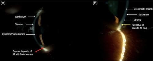 A side-by-side clinical slit-lamp photograph comparing two types of corneal rings. Image (A) shows a Kayser-Fleischer (KF) ring in a patient with Wilson’s Disease, characterized by distinct copper-colored deposits located at the level of the Descemet's membrane in the inferior cornea. Image (B) demonstrates a Pseudo-Kayser-Fleischer (PKF) ring associated with hyperbilirubinemia, presenting as a faint yellow hue within the posterior stroma rather than the Descemet's membrane. Both images include anatomical labels for the epithelium, stroma, and Descemet's membrane to provide depth context. The comparison highlights the different anatomical localization and coloration of copper versus bilirubin deposits, which is a critical diagnostic distinction in patients presenting with liver disease and ocular findings.