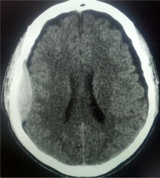 This diagnostic image is an axial slice from a non-contrast Computed Tomography (CT) scan of the head, representing a critical finding in neurosurgery and emergency medicine. The image demonstrates a classic biconvex (lenticular) hyperdense extra-axial collection in the right parietal region, characteristic of an acute epidural hematoma. The hyperdensity represents acute blood localized between the inner table of the skull and the dura mater. Notable mass effect is observed, evidenced by the inward compression of the underlying brain parenchyma and a subtle midline shift of the falx cerebri towards the left. The cerebral ventricles appear partially compressed. The high-density white outer rim represents the calvarium, while the brain tissue shows typical gray-white matter differentiation. This educational visual is used to teach the radiological hallmarks of intracranial hemorrhage following head trauma, specifically distinguishing the biconvex shape of an epidural hematoma from the crescent-shaped presentation of a subdural hematoma.