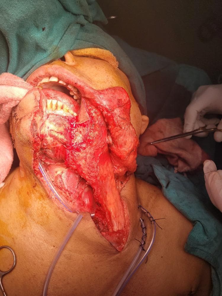 This intraoperative clinical photograph displays a complex head and neck reconstruction using a pectoralis major myocutaneous (PMMC) flap in a patient following oncological resection for oral cavity cancer. The surgical site spans the lower face, oral cavity, and neck. A bulky, reddish-pink, vascularized muscle flap is visible being tunneled and transposed from the chest to reconstruct a significant defect in the buccal mucosa and oral floor. Key anatomical landmarks include the exposed mandibular teeth, oral vestibule, and the submental region. The neck is opened as part of a modified radical neck dissection, with surgical sutures clearly visible at the inferior incision margin. Two clear suction drainage tubes are positioned within the neck wound bed to prevent fluid accumulation. Surgical instruments, including forceps and scissors, are visible in the periphery, manipulated by gloved surgical staff. The image illustrates the clinical application of a pedicled myocutaneous flap for primary reconstruction of large-volume soft tissue defects in head and neck surgery.