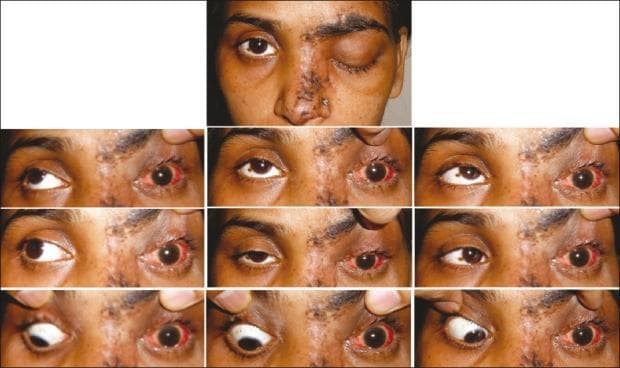 Clinical photograph series documenting a patient with Herpes Zoster Ophthalmicus (HZO) and associated complications. The primary image displays a unilateral vesiculopustular rash and hemorrhagic crusting following the V1 ophthalmic distribution of the trigeminal nerve on the left side, involving the forehead, periocular region, and bridge of the nose (Hutchinson's sign). Marked ophthalmological findings in the left eye include severe ptosis and conjunctival hyperemia. Below, a nine-gaze montage demonstrates a complete limitation of ocular motility (ophthalmoplegia) in the left eye across all cardinal directions of gaze, while the right eye shows normal motility. The clinical presentation is highly suggestive of Orbital Apex Syndrome, characterized by the involvement of cranial nerves III, IV, VI, and the ophthalmic branch of V. This visual material is used in medical education to illustrate the dermatological manifestations of HZO and the neuro-ophthalmological complications associated with viral reactivation in immunocompromised states.