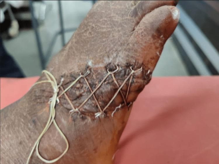This clinical photograph shows a superior view of a traumatic laceration on the dorsolateral aspect of a human foot, illustrating a specialized wound closure technique. The wound is managed using a 'shoelace' suture technique, where a thin, light-colored suture material (Ethibond) is threaded in a criss-cross, zig-zag pattern through surgical skin staples placed along the wound margins. This technique allows for gradual approximation of skin edges to manage tension and skin loss. The underlying wound bed appears dark and granulated, consistent with a healing stage involving platelet-rich plasma (PRP) infiltration. The surrounding skin is dry, hyperkeratotic, and slightly desquamated, with no evident signs of acute purulent infection. This image demonstrates an orthopedic surgical approach for managing complex soft tissue defects associated with high-energy trauma and open fractures, specifically highlighting tension-reduced primary closure methods in areas with limited skin mobility.