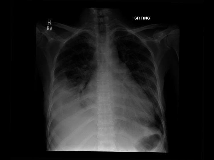 Anteroposterior (AP) chest X-ray in a sitting position demonstrating several findings consistent with pulmonary venous hypertension and fluid overload. The cardiac silhouette is enlarged, indicating cardiomegaly. Notable pulmonary vascular changes include cephalization, where upper lobe vessels appear prominent and distended. Perihilar congestion is evident with increased opacification and blurring of the hilar structures. A moderate right-sided pleural effusion is present, characterized by the blunting and obscuration of the right costophrenic angle, likely associated with underlying compressive atelectasis in the adjacent lung base. The combined findings of cardiomegaly, vascular redistribution, and pleural effusion are highly suggestive of congestive heart failure. The mediastinal structures remain midline, and the bones and soft tissues appear unremarkable within the field of view.