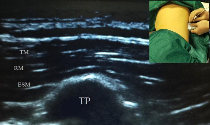 This composite educational image illustrates the performance of an Erector Spinae Plane Block (ESPB). The main diagnostic image is a high-frequency ultrasound of the paraspinal region in a sagittal or parasagittal view. It depicts the layered muscular anatomy superficial to the vertebral column: the trapezius muscle (TM) is the most superficial layer, followed by the rhomboid major (RM), and the thick erector spinae muscle (ESM) deeper. Below the ESM, a hyperechoic, rounded structure with acoustic shadowing is identified as the transverse process (TP) of the thoracic vertebra. The inset in the upper-right corner is a clinical photograph showing the procedural setup, where a practitioner is performing an out-of-plane needle insertion with a lateral-to-medial approach relative to the ultrasound probe placed on the patient's back. This visual material is designed to teach the identification of ultrasound landmarks and needle trajectory for regional anesthesia, specifically targeting the fascial plane deep to the erector spinae muscle and superficial to the transverse process.