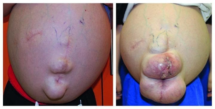 This comparison clinical photograph documents the progressive abdominal enlargement in a patient over a 17-month period. The initial visit (left) shows severe abdominal distension, consistent with massive ascites, featuring visible superficial reticular veins (caput medusae-like appearance), surgical scars, and a midline umbilical protrusion. The follow-up image (right) demonstrates a significant worsening of the condition. The abdomen is more globular and tense, with more prominent, tortuous green-blue superficial vasculature. Notably, the umbilical region now exhibits a large, multi-lobulated protrusion, likely representing a massive umbilical or ventral hernia. This mass shows signs of skin tension, erythema, and localized ulceration with crusting, indicating potential skin breakdown or incarceration. These findings are clinically relevant for chronic liver disease with portal hypertension or complex congenital anomalies, illustrating the physical manifestations of progressive intra-abdominal pressure and the associated risk of herniation and integumentary compromise.