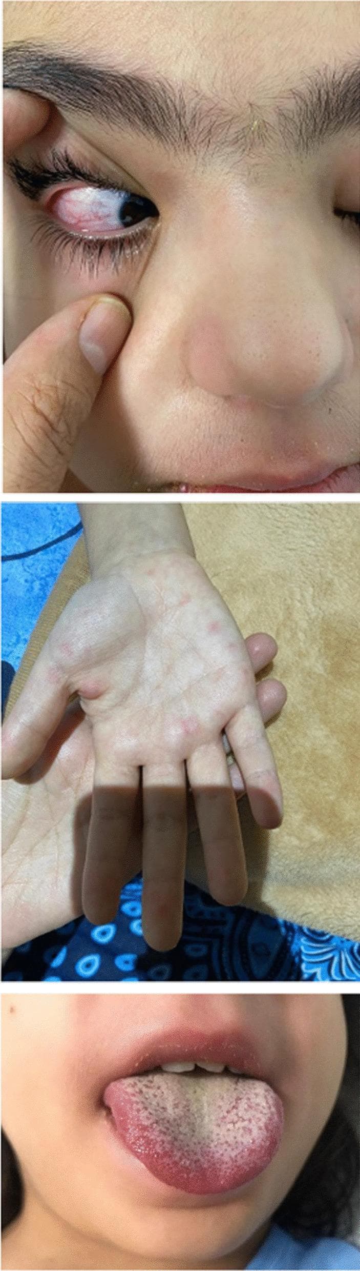 A composite of three clinical photographs illustrating diagnostic signs of Kawasaki Disease in a pediatric patient. The top image shows the right eye with bilateral, nonpurulent bulbar conjunctival injection; the sclera is markedly erythematous without exudate or discharge. The middle image displays the palmar surface of the hand, exhibiting a maculopapular rash characterized by discrete, erythematous lesions on the palm and fingers. The bottom image shows an oropharyngeal examination revealing a classic 'strawberry tongue,' featuring a bright red, edematous appearance with prominent, hypertrophied fungiform papillae against a white-coated dorsal background. Together, these visual findings—conjunctival sparing, peripheral extremity changes, and mucosal inflammation—serve as key clinical criteria for diagnosing Kawasaki Disease or Multisystem Inflammatory Syndrome in Children (MIS-C).