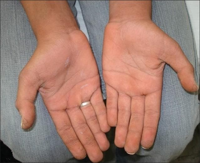 Clinical photograph of the palmar surfaces of both hands demonstrating features consistent with palmoplantar keratoderma (PPK). The image shows bilateral, symmetrical thickening of the skin (hyperkeratosis) with an exaggerated appearance of the dermatoglyphics (skin lines). The palms exhibit a yellowish-orange hue, particularly within the creases and over pressure-bearing areas. Small, scattered white patches or focal areas of desquamation are visible, suggesting scaling or dryness. The texture appears rough and leathery compared to normal palmar skin. No significant fissures or erythematous borders are visible in this specific presentation. This visual finding is characteristic of a group of hereditary or acquired disorders of cornification, often associated with systemic conditions such as Bart-Pumphrey syndrome when occurring alongside leukonychia totalis and sensorineural hearing loss (SNHL).