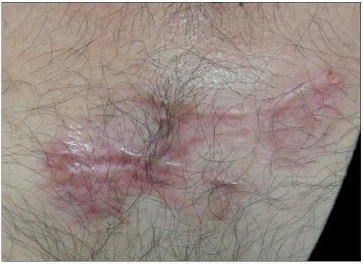 This clinical photograph displays a close-up view of a treated keloid on hair-bearing skin, one year after CO2 laser ablation and adjuvant intralesional triamcinolone acetonide therapy. The resulting scar is predominantly flat with a supple, parchment-like texture and visible skin lines, indicating successful resolution of the prior bulk. The scar exhibits a complex pigmentary pattern, including areas of hypopigmentation (depigmentation) and mild erythema with visible telangiectasias, suggesting chronic vascular changes or residual inflammation. The scar morphology is linear with minor branching patterns. Hair follicles are present in the immediate vicinity and partially overlap the edges of the scar tissue. This image serves as a clinical reference for the expected long-term outcome and potential local side effects, such as atrophy and vascular abnormalities, following combined surgical and corticosteroid treatment for hypertrophic or keloid scarring.