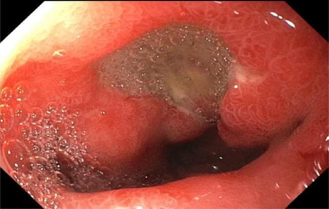 This endoscopic clinical photograph displays a 7 mm cratered ulcer located in the duodenal bulb, a common manifestation of peptic ulcer disease. The ulcer is characterized by a central, depressed crater filled with a brownish-gray fibrinous base and mucus. The surrounding duodenal mucosa is intensely erythematous and edematous, indicating active inflammation (duodenitis). Visible mucosal changes include a granular texture and prominent mucosal folds. Bubbles from gastric secretions are present in the foreground, indicating the fluid-rich environment of the upper gastrointestinal tract. This visual is representative of H. pylori-associated ulceration or NSAID-induced mucosal injury, providing a classic example for gastroenterology and internal medicine education regarding diagnostic upper endoscopy (esophagogastroduodenoscopy) and the morphological evaluation of duodenal lesions.