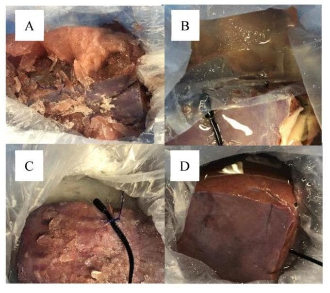 This composite of four clinical photographs (labeled A–D) demonstrates the macroscopic findings of experimental liver grafts following six hours of cold storage under different preservation protocols. The images contrast the impact of freezing temperatures on organ integrity and University of Wisconsin (UW) solution consistency. Panel A shows severe freezing injury with a fragmented liver graft surrounded by extensive ice crystal formation. Panel B displays a graft with surface condensation and a wet appearance, suggesting a partially frozen or thawing state. Panel C illustrates an intact liver graft but with visible superficial frosting and condensation, indicating moderate ice crystal formation. Panel D serves as a successful preservation model, showing an intact liver graft with a smooth, glossy surface and normal anatomical color, entirely devoid of visible ice or freezing injury. This comparison is clinically relevant for evaluating organ packaging techniques and the efficacy of thermal barriers, such as lactated Ringer’s solution layers, in preventing accidental graft freezing during transport and storage in transplant medicine.